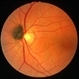 Optic nerve melanocytoma 2
